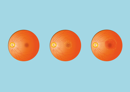 Macular degeneration, illustration