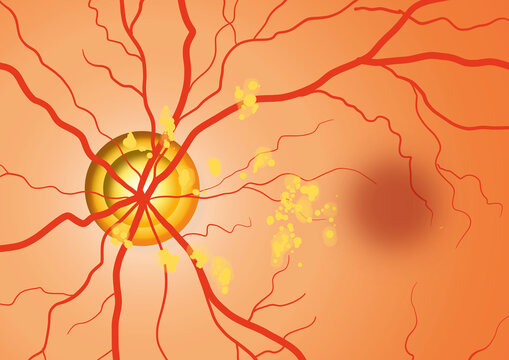 Dry macular degeneration, illustration