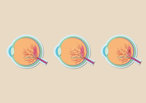 Macular degeneration, illustration