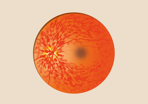 Retinal vein occlusions, illustration