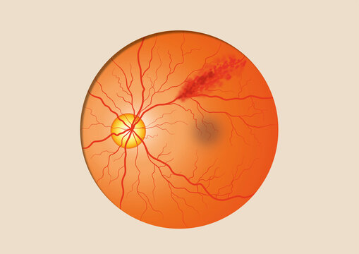 Retinal vein occlusion, illustration