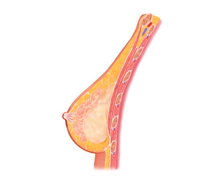 Implant based breast reconstruction, illustration