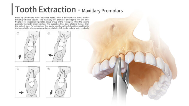 Upper tooth removal surgery, illustration