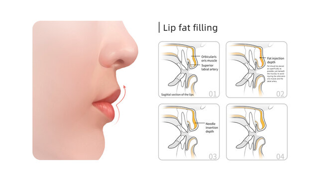 Lip fat filling, illustration