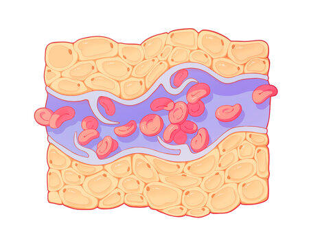 Chest wall Mondor disease, illustration