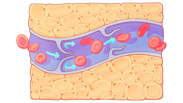 Chest wall Mondor disease, illustration