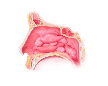 Nasal polyp, illustration
