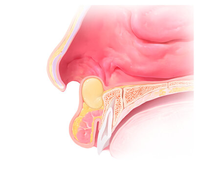 Nasal vestibule cyst, illustration