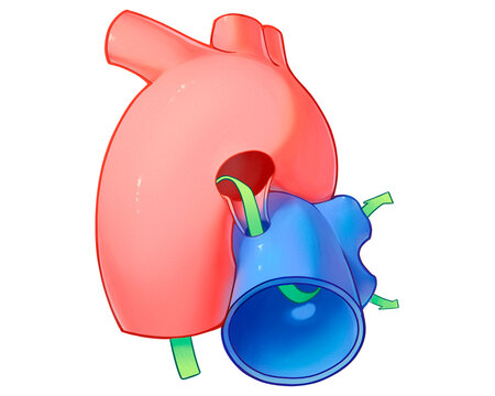 Funnel type patent ductus arteriosus, illustration
