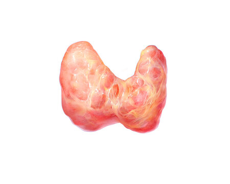 Overactive enlarged thyroid, illustration