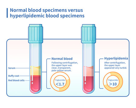 Hyperlipidaemia blood sample comparison, illustration
