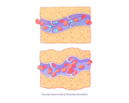 Blood flow direction in Mondor's disease, illustration