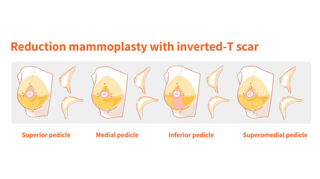 Inverted-T incision in reduction mammaplasty, illustration