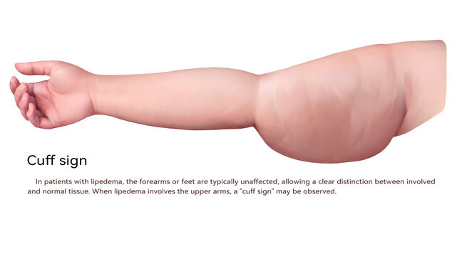 Lipedema cuff, illustration