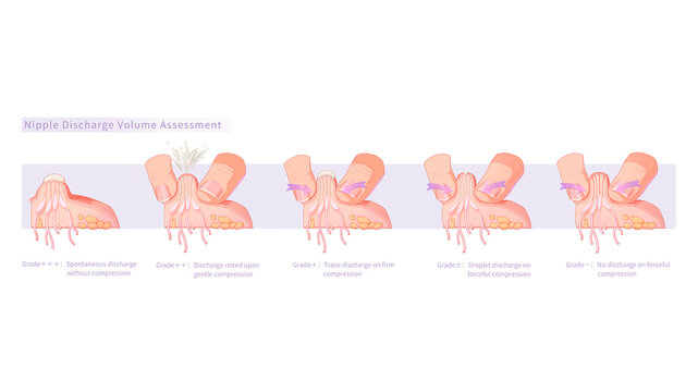 Nipple discharge volume assessment, illustration