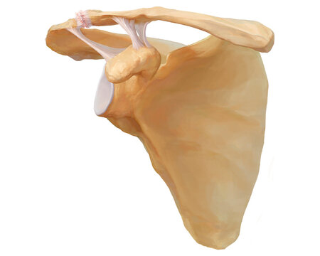 Acromioclavicular dislocation type II, illustration