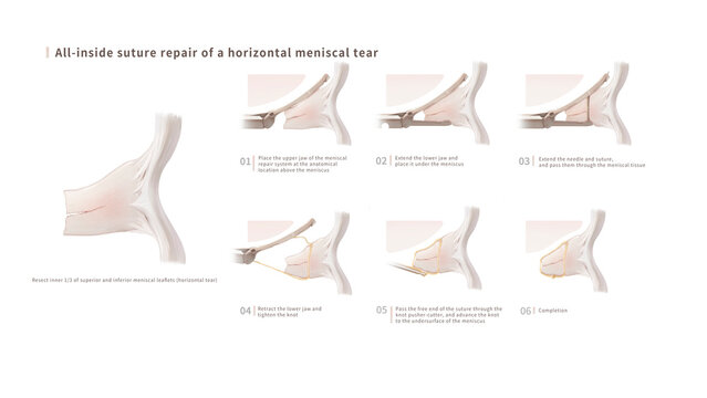 Meniscus horizontal tear all-inside suture, illustration