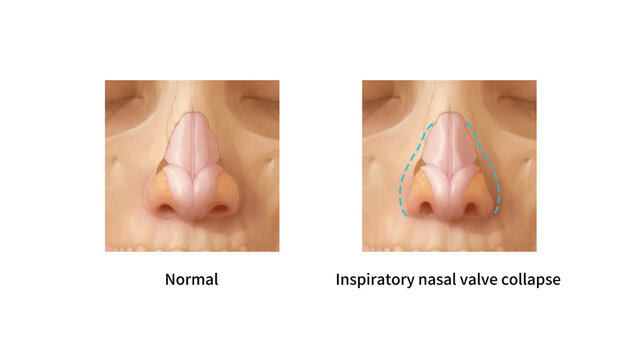 Nasal valve collapse vs normal, illustration
