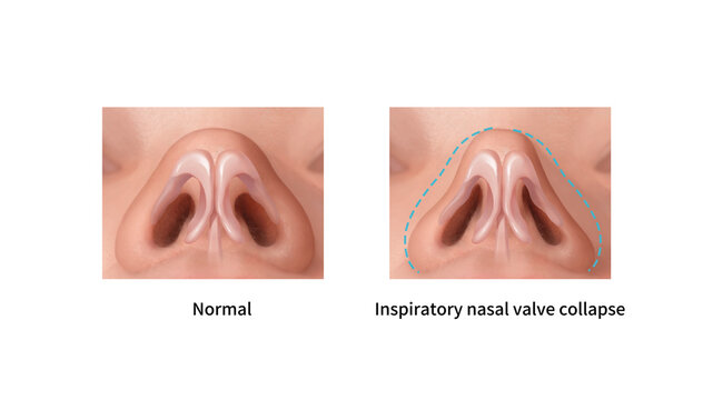 Nasal valve collapse vs normal, illustration