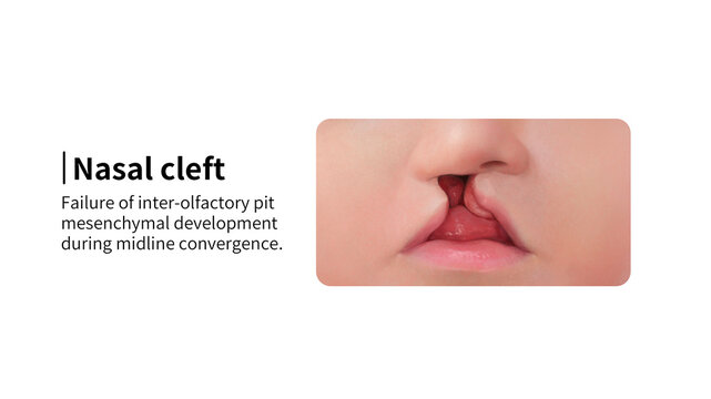 Complete unilateral cleft lip and palate, illustration
