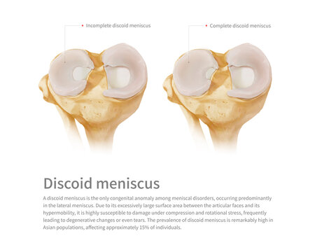 Discoid meniscus, illustration