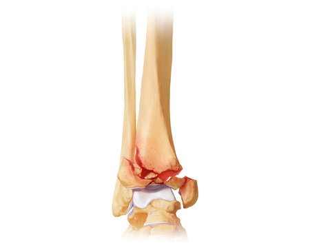 Distal tibia fracture AO-C3.1, illustration