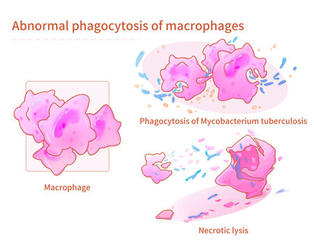 Tuberculous mastitis-macrophage phagocytosis, illustration