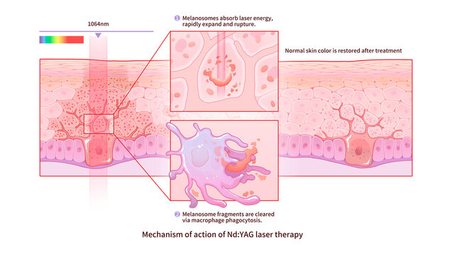 Nd-YAG laser treatment mechanism, illustration