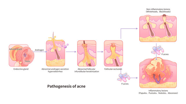 Acne pathogenesis, illustration