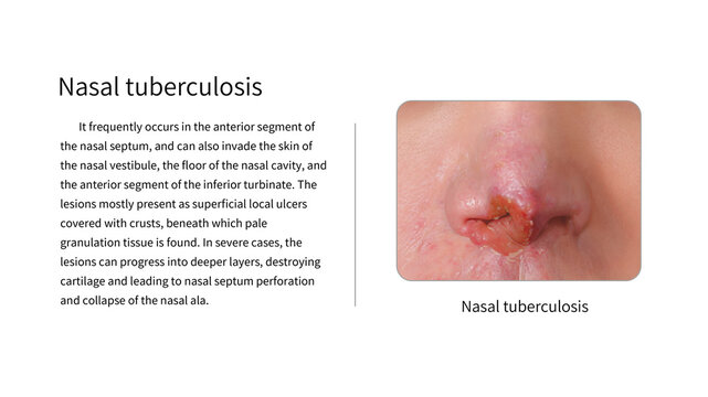 Nasal tuberculosis, illustration