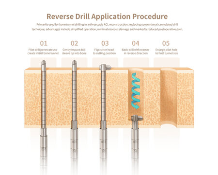 Retrograde drill usage, illustration