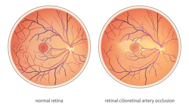 Retinal ciliary artery occlusion, illustration