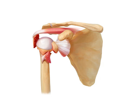 Proximal humerus fracture Neer type 2, illustration