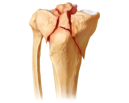 Tibial plateau fracture Schatzker V, illustration