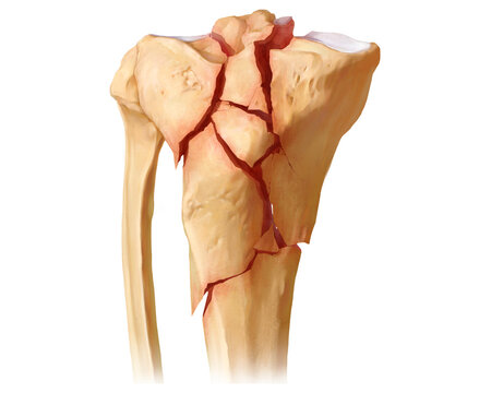 Tibial plateau fracture Schatzker VI, illustration