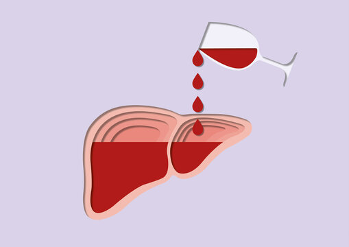 Alcoholic liver damage, conceptual illustration