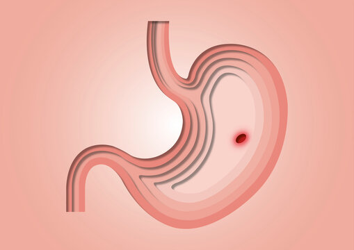 Stomach ulcer, conceptual illustration