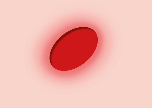 Ulcer, conceptual illustration