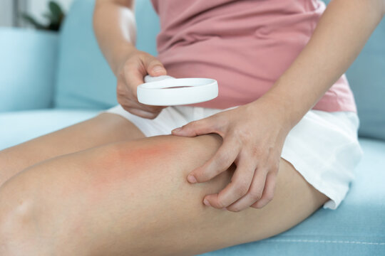 skin problem and beauty. Young woman scratch skin leg has itchy skin, allergic, steroid allergy, sensitive skin, red from sunburn, chemical allergy, rash, insect bites, Seborrheic