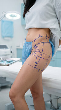 Side view of woman's hip with blue surgical markings for procedure, hospital setting, medical treatment concept. Plastic surgery, healthcare, medical science.