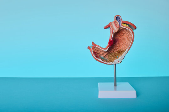 Cross section anatomical stomach model demonstrating stomach ulcer and peptic disease therapy.