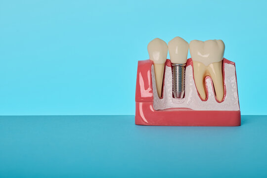 Dentistry implant model horizontal view. Prosthetic tooth restoration and dental crown installation.