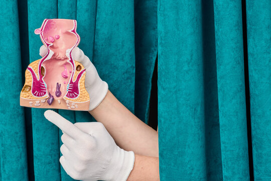 Doctor gloved hand pointing at anatomical model of rectum and anal canal with hemorrhoids. Proctology consultation and hemorrhoid treatment.