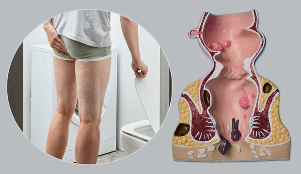 Medical collage combining a man holding his buttocks in pain by the toilet with an anatomical model of rectal hemorrhoids during a comprehensive gastroenterology consultation.