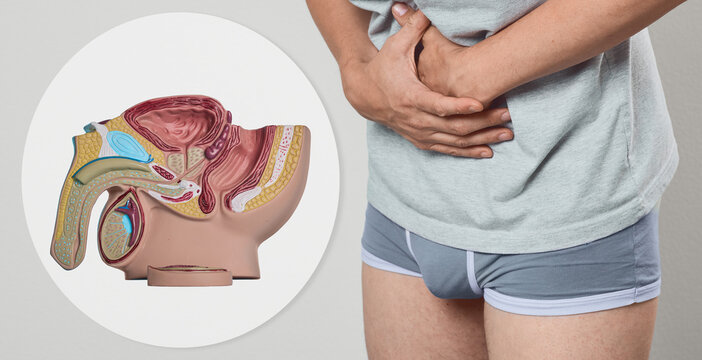 Medical collage showing prostate disease pathology visual aid and man experiencing acute abdominal spasm. Urologist exam and pelvic organ inflammation therapy.
