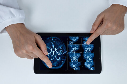 Doctors hands pointing at a digital brain angiography scan displayed on a tablet computer. Advanced neuroimaging and cerebral vascular diagnostics concept