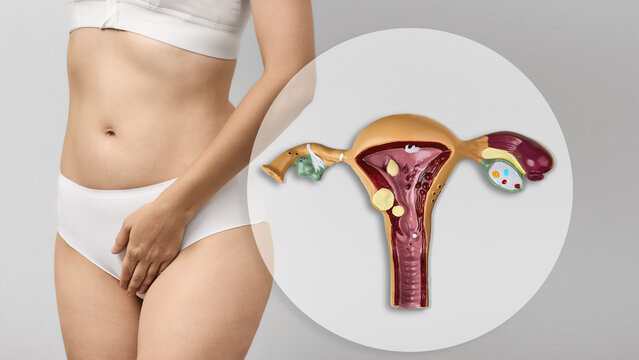 Female model in white bra and panties positioned next to a graphic uterine diagram. Uterine anomaly, ovarian cyst, and hormonal imbalance concept.
