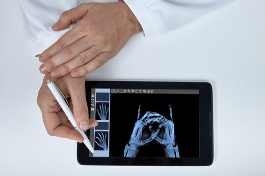 Doctor pointing with a pen at a digital hand bone X-ray on a tablet screen. Rheumatoid arthritis symptoms, joint inflammation, and hand deformity checkup.