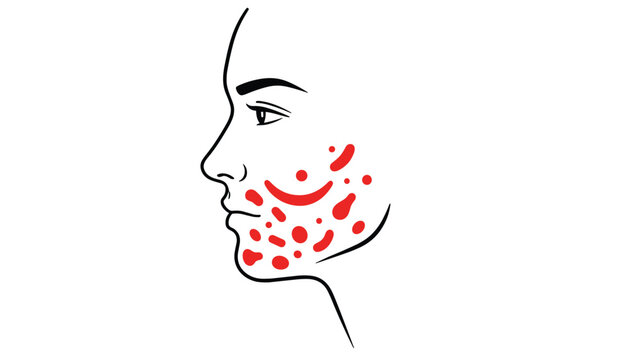 Female profile line drawing illustrating acne breakouts and red skin blemishes on the cheek and jawline area.