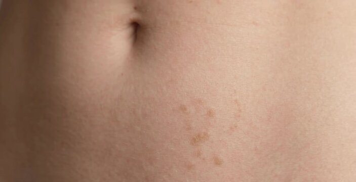 Macro Close Up of Clustered Hyperpigmentation and Light Brown Birthmark Patches on Woman Abdomen